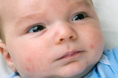 Ученые объяснили, как избавить ребенка от аллергии