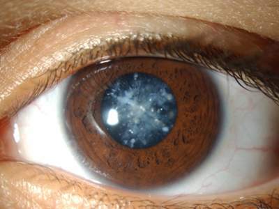 Эффективные меры профилактики катаракты